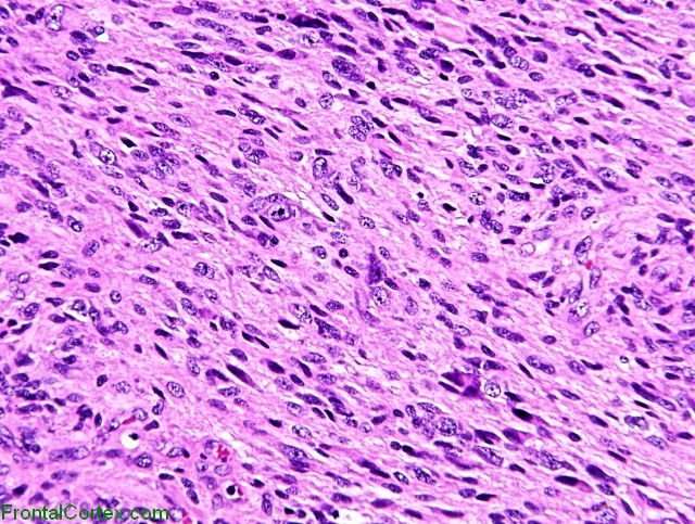 Desmoplastic infantile ganglioglioma, H&E stain x100